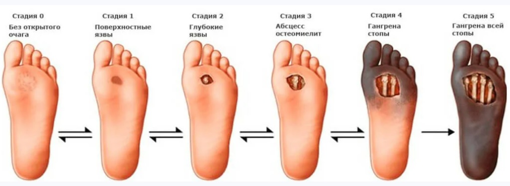 синдром диабетической стопы