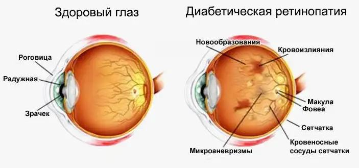 Сахарный диабет и болезни глаз