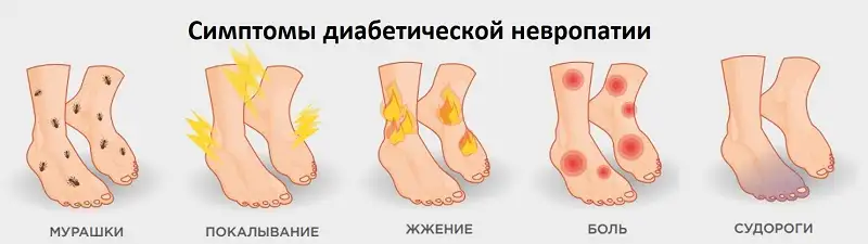 Симптомы диабетической невропатии