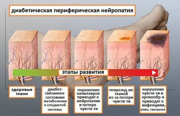 Стадии развития диабетической невропатии