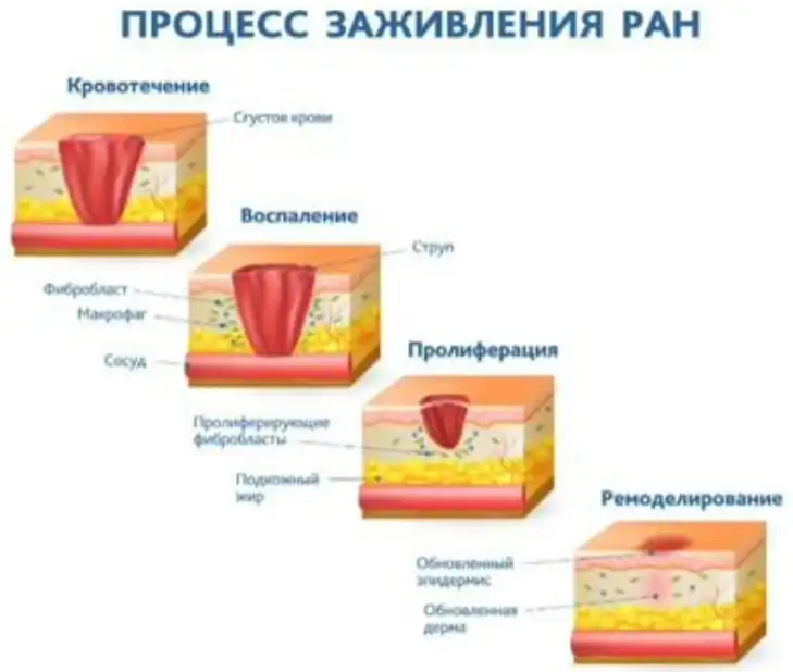 Процесс заживления ран
