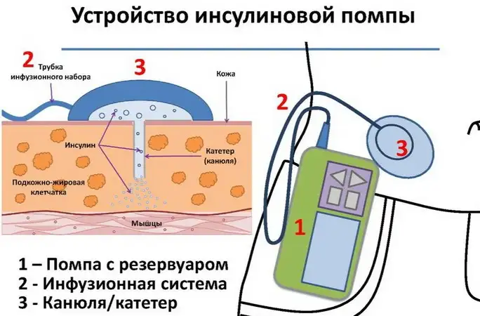 Устройство инсулиновой помпы