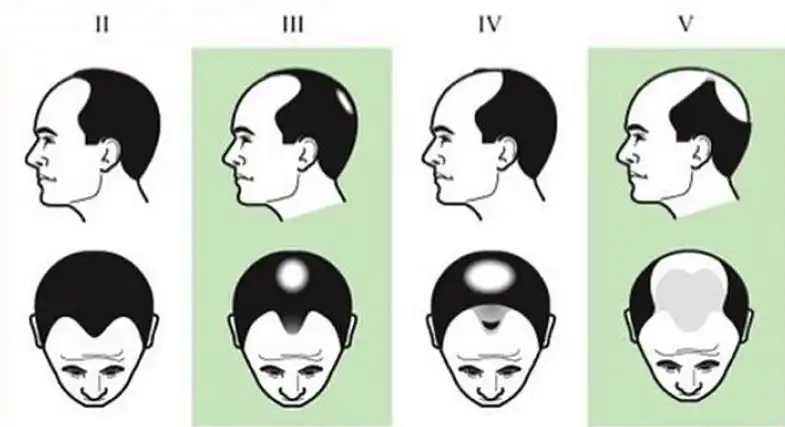 Стадии облысения