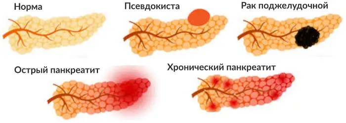Панкреатит и поджелудочная железа