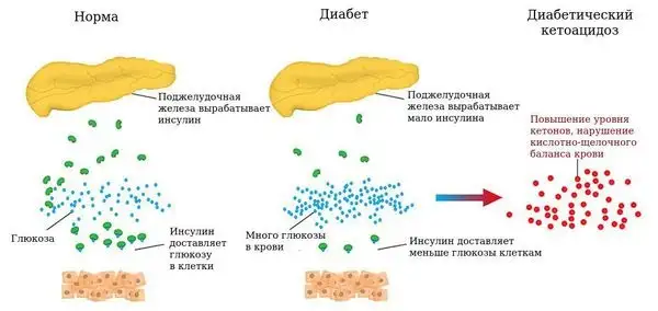 Повышение уровня кетонов