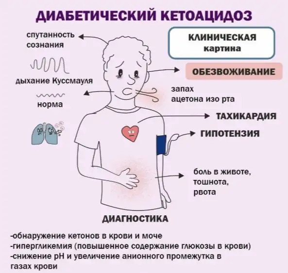 Диабетический кетоацидоз. Клиническая картина