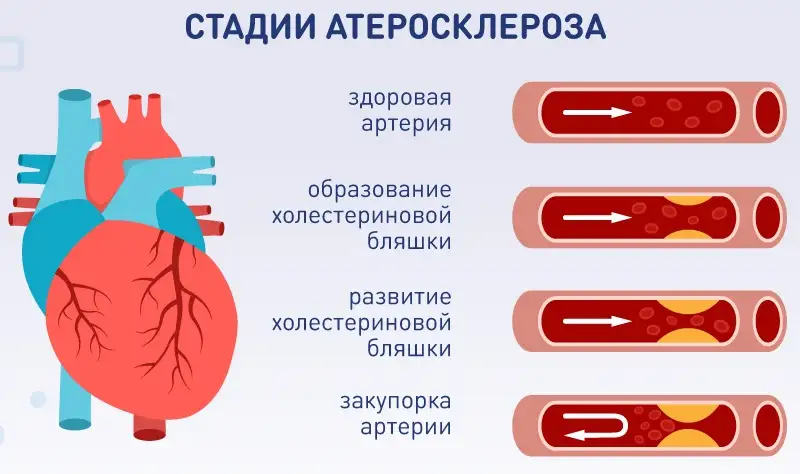 Стадии атеросклероза
