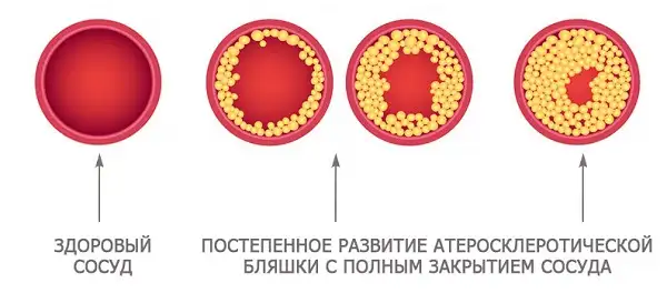 Сосуды с высоким уровнем атеросклероща могут привести к образованию тромбов и смерти