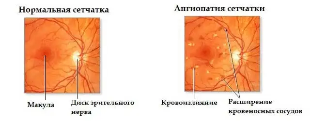 Ангиопатия сетчатки