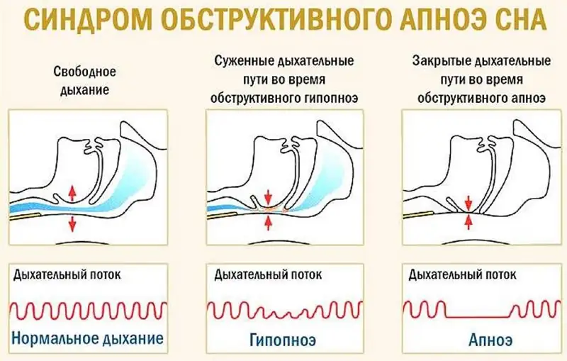 Синдром обструктного апноэ сна может привести к смерти