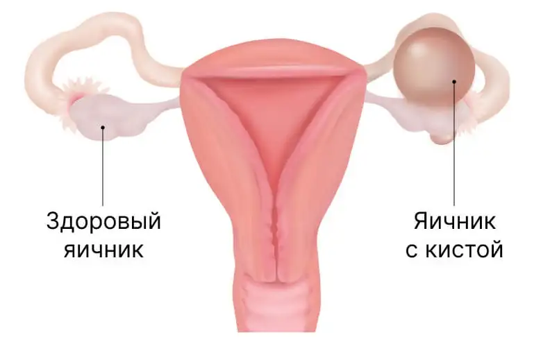 Киста яичника у женщин