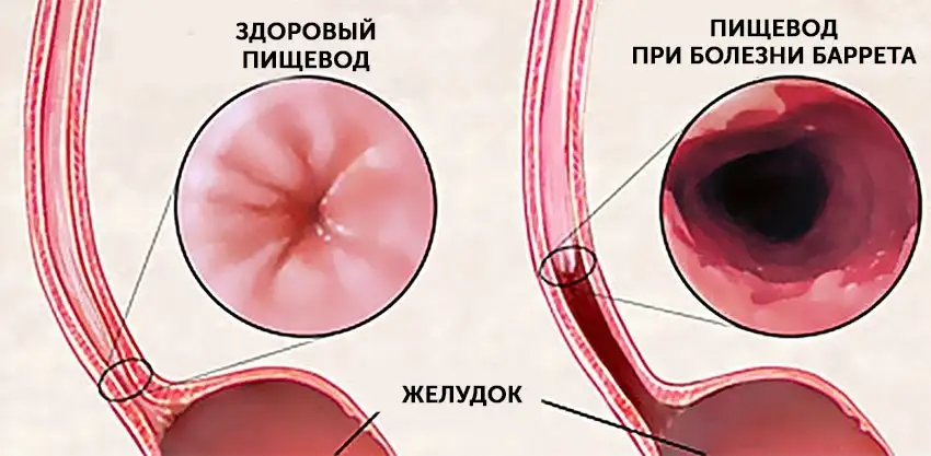 Пищевод при болезни Баррета